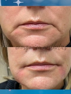 View Lips, LED Acne Therapy, Dermaplaning, PRP Facial, HydraFacial, Upper Face, Eyes, Lower Face, Body Sculpting, Low-Level Laser Therapy, Radio Frequency, Skin Treatments, Forehead, Nose, Chin, Minimally Invasive, Neck Tightening, Filler, Cheeks, Smile Lines, Cosmetic, Skin Treatments, Neurotoxin, Facial, Chemical Peel, Microdermabrasion, Microneedling - Jen Phillips-Kiernan, Round Rock, TX
