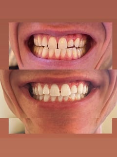View Teeth Whitening, Dentistry, Teeth Bleaching, Dentistry Services - Carolina Guillermo, New York, NY