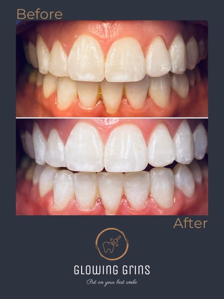 Image of  Teeth Whitening, Cosmetic