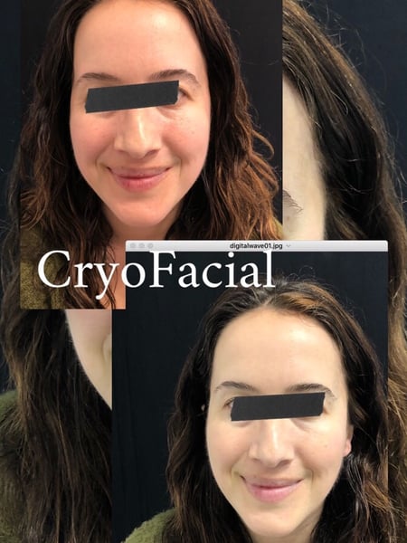 Image of  Cosmetic, Mini Facelift, Minimally Invasive, Skin Treatments, Facial