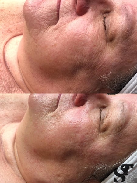 Image of  Facial, Skin Treatments, Microdermabrasion