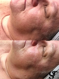 View Facial, Skin Treatments, Microdermabrasion - Meegwun Desjarlait, Golden Valley, MN
