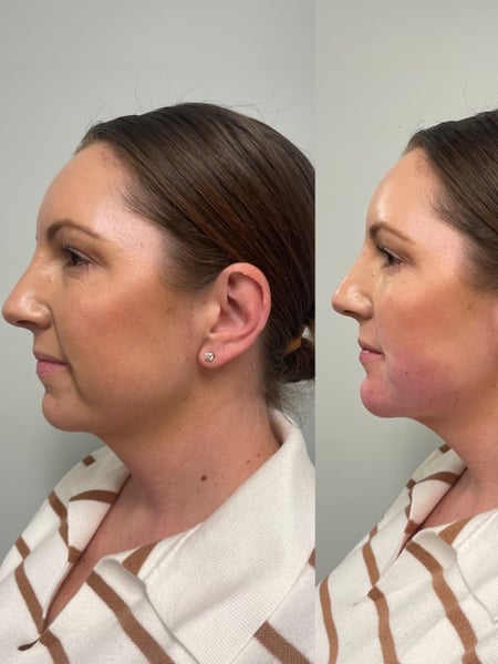 Image of  Chin, Filler, Cheeks, Smile Lines, Cosmetic, Skin Treatments, Facial, Skin Treatments