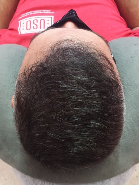 Image of  Cosmetic, Cosmetic Tattoos, Scalp Micropigmentation