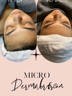 View Facial, Microdermabrasion, Skin Treatments, Cosmetic - Jasmine Coleman, Oakland, CA