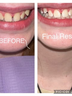 View Teeth Whitening, Dentistry, Dentistry Services - Kai Kai Phelps, Omaha, NE