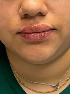 View Lips, Filler, Cosmetic - Tamala Flack, San Antonio, TX