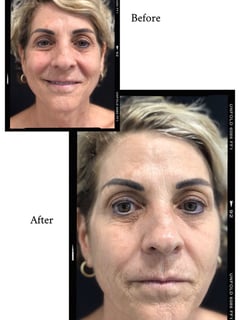 View Cosmetic, Mini Facelift, Minimally Invasive, Skin Treatments - Shilo Hope Stanley, La Mesa, CA