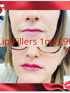 View Cosmetic, Filler, Lips - Margaret turnbull, 